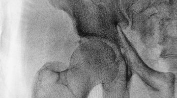 picture of a hip joint